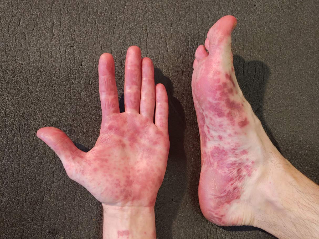 "Casco Epidémico: El Virus Coxsackie Extiende Su Influencia Por Todo El País, Con Mínimo De 63 Municipios Afectados"